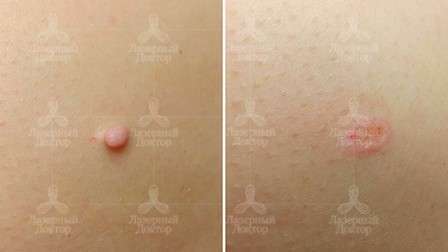 удаления фибромы