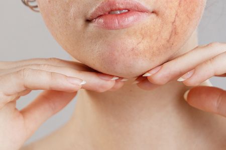 Красные капилляры на лице