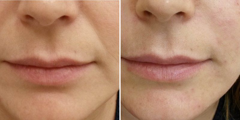 Чем убирают носогубные складки?