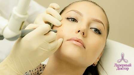 удаление родинок на лице