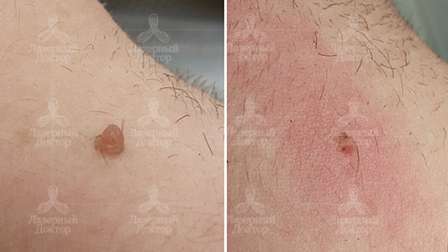 папилломы на шее