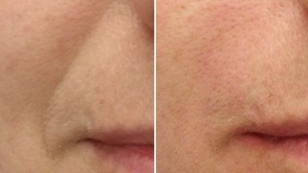 Филлеры в косметологии