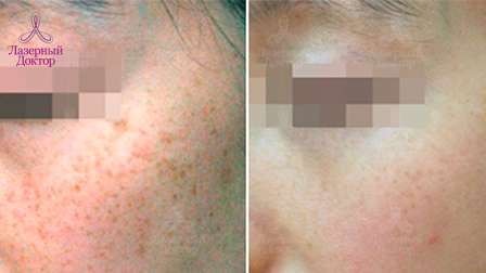 Удаление веснушек