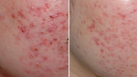 Заболевание акне