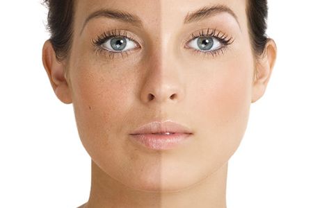 мелазма что это такое