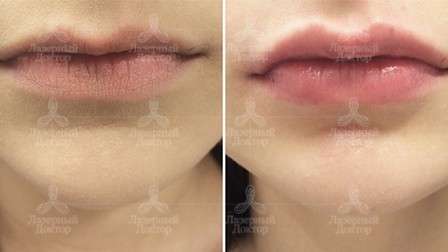 увеличения губ