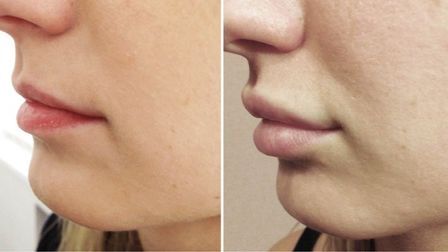 Филлер - это?