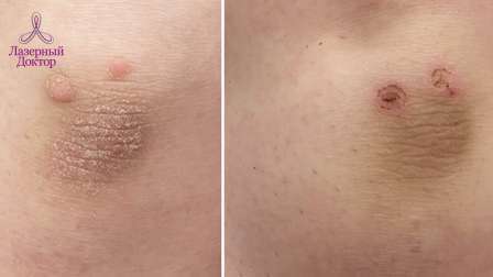 плоские бородавки