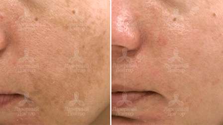 проблемы пигментации