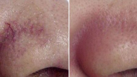 Лазерное удаление купероза