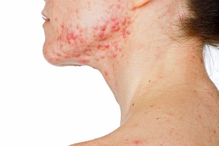 вульгарные угри фото лечение