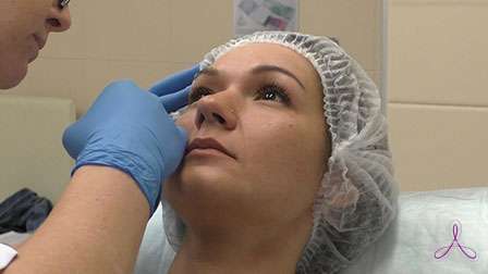 ботэкс в уголках глаз