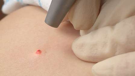 удаления родинок