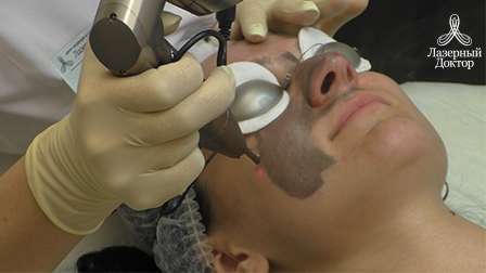 процедура карбоновый пилинг