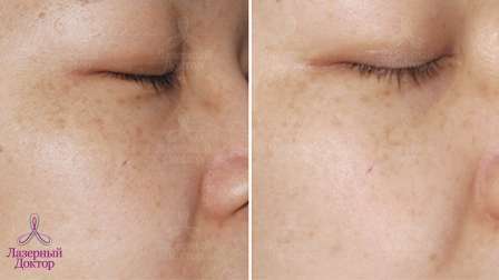 Удаление веснушек лазером