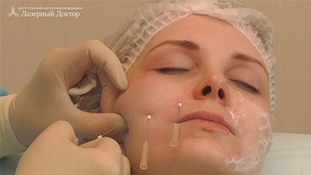 тредлифтинг