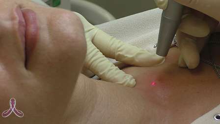 удаления родинок