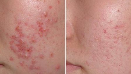 Лазер - лучшее средство от угрей и прыщей.