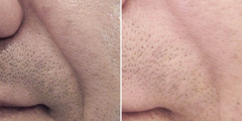 Как убрать носогубную складку?