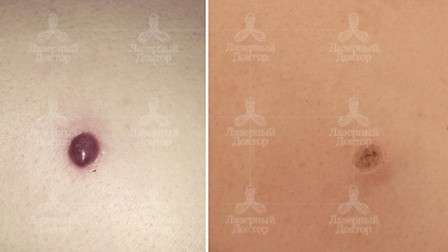 красная родинка