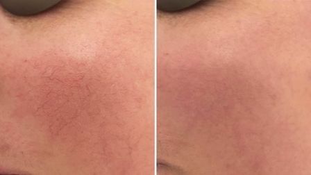 Лечение купероза на лице лазером