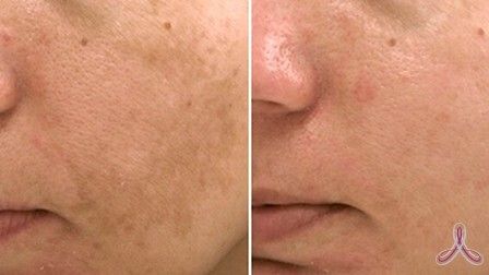 мелазма до и после