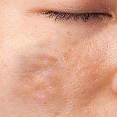 Инъекционное удаление келоидных рубцов