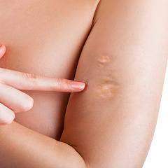 Удаление келоидных шрамов на теле инъекциями