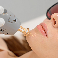 Удаление сосудов Candela