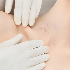 Лечение контагиозного моллюска - удаление лазером на теле