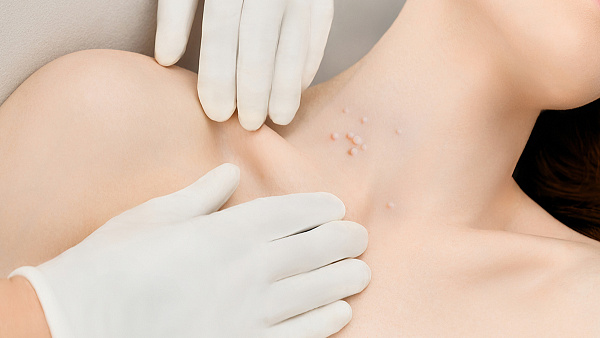 Лечение контагиозного моллюска - удаление лазером на теле