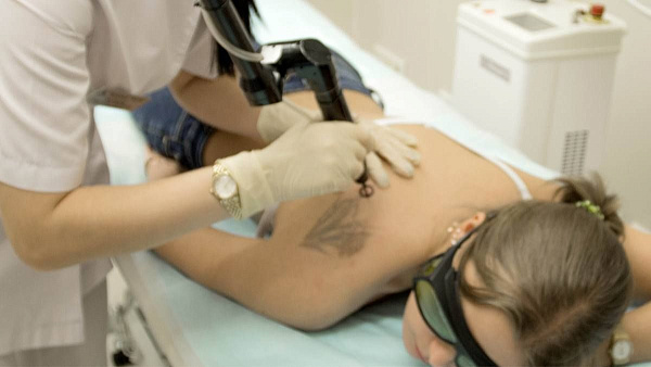 Удаление татуировок неодимовым лазером Q-Switched ND:Yag