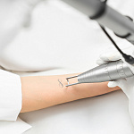 Лазерное удаление татуировок