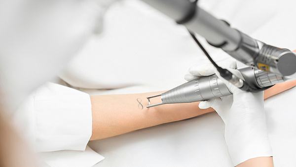 Лазерное удаление татуировок