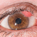 Папилломы на веке: причины, симптомы, методы удаления