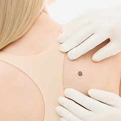 Лечение: удаление кератомы на теле