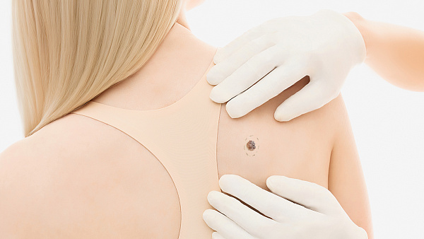 Лечение: удаление кератомы на теле