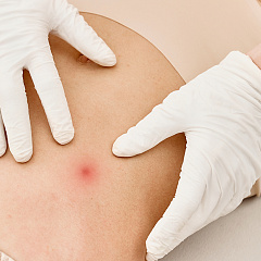 Лечение фибромы кожи - удаление лазером на теле