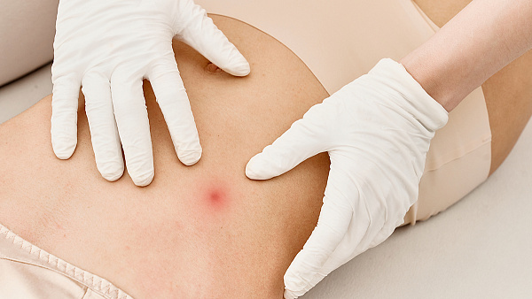 Лечение фибромы кожи - удаление лазером на теле