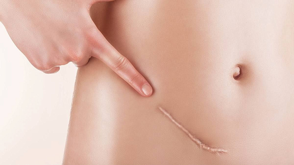 Удаление келоидных рубцов на теле лазером "Ланцет"