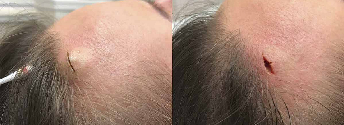 Удаление атеромы