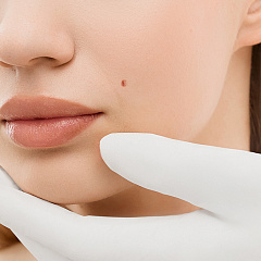 Удаление родинок лазером на лице и шее