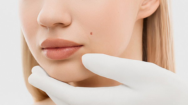 Удаление родинок лазером на лице и шее