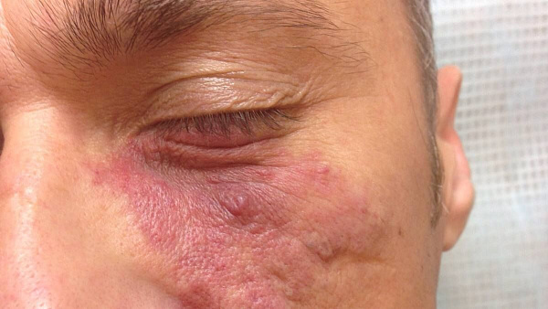 Удаление гемангиомы