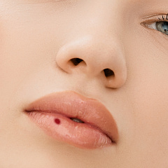 Лечение ботриомикомы