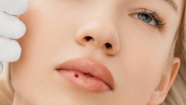 Лечение ботриомикомы