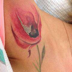 Удаление цветных татуировок на лазере SPECTRA