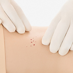 Лечение ангиомы кожи: удаление лазером на теле