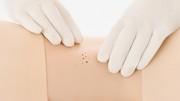 Лечение ангиомы кожи: удаление лазером на теле