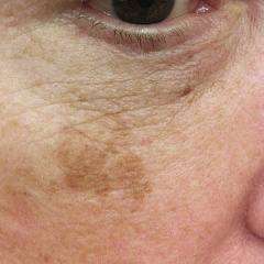 Удаление пигментных пятен лазером SmartXide Dot